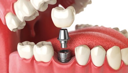 Одноэтапная имплантация системами MIS, Straumann с пожизненной гарантией