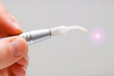 Лазерная терапия периодонтальных карманов